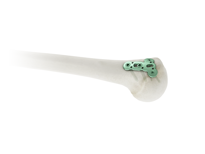 Humerus Greater Tubercle Locking Plate