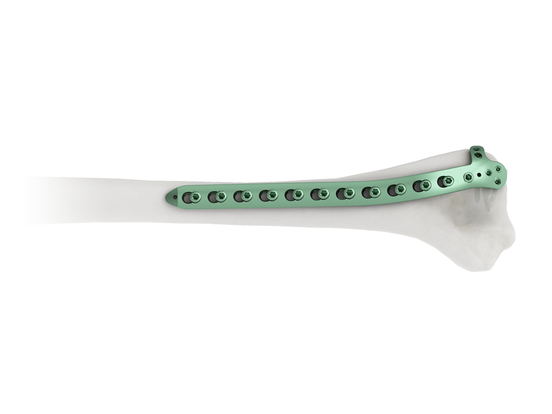 Distal Humerus medial  Locking Plate B